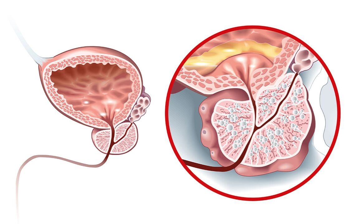 Ce se întâmplă cu prostata cu adenom și prostatita