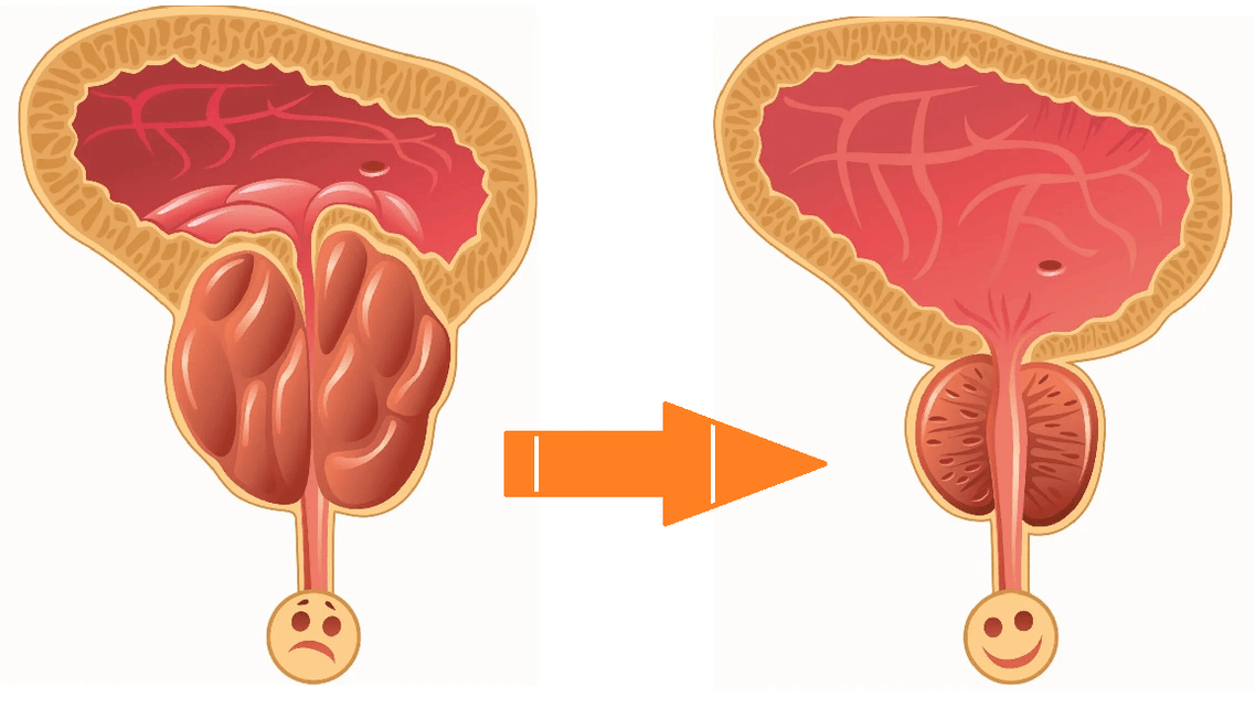 Efectul Uromexil Forte asupra prostatei cu prostatită și adenom